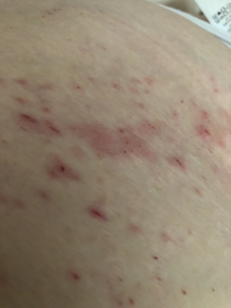 Worried about this rash