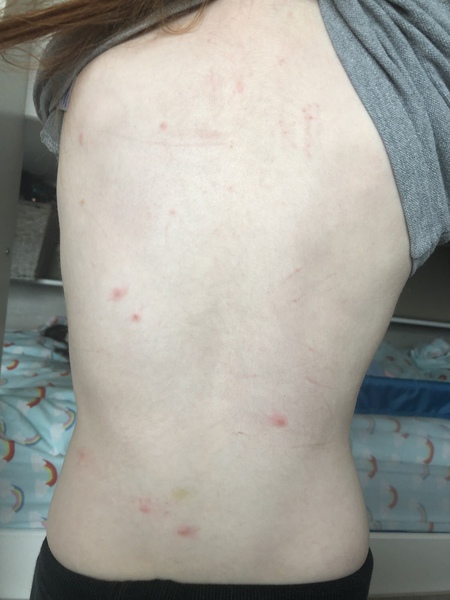 Help. Urgent. Is this chickenpox or just hives?