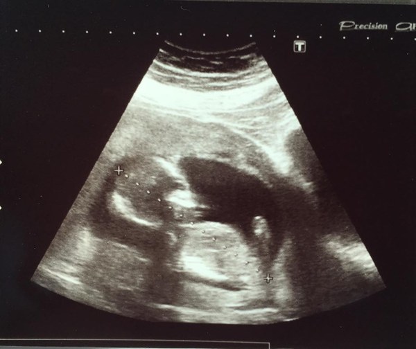 Boy Or Girl????