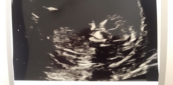 Boy or girl guesses - nub techs inconclusive!