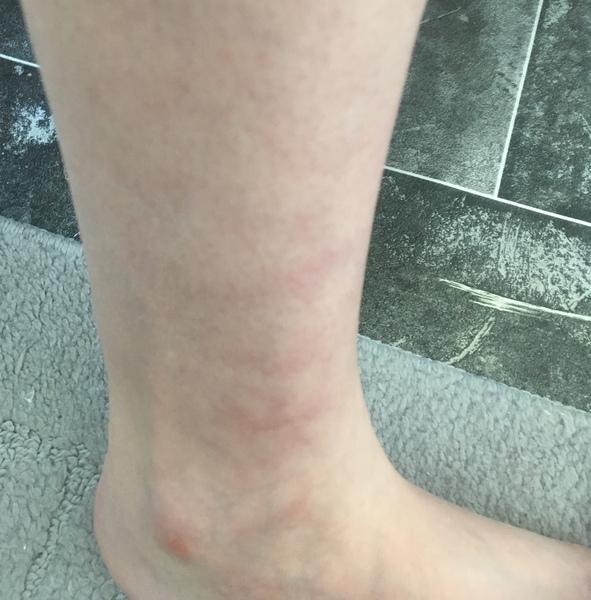 Ache/pain in my ankle and shin