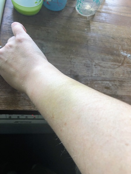 Anyone get bruises they can’t remember getting?