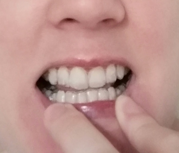 Invisalign- tell me to woman up!