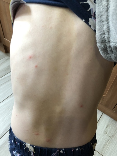 Help. Urgent. Is this chickenpox or just hives?