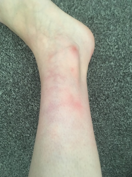 Ache/pain in my ankle and shin