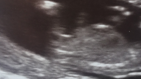 Nub/skull theory boy or girl?