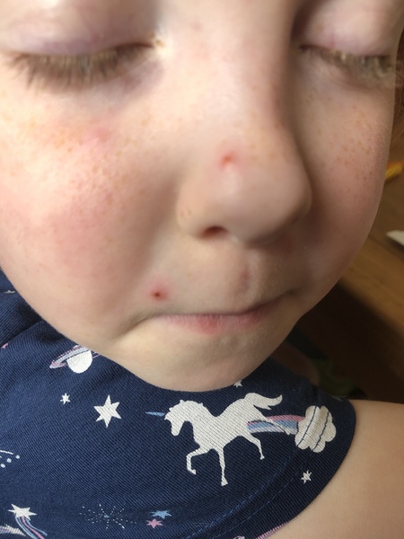 Help. Urgent. Is this chickenpox or just hives?