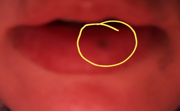 Freckle on lip ??