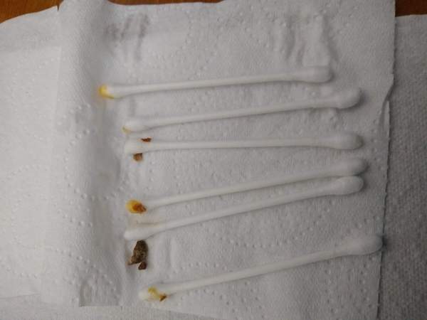 ****Klaxon**** DH's Earwax.  With Pics!