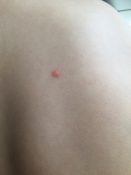 To ask if this looks like chicken pox?