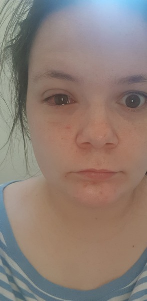 Conjunctivitis