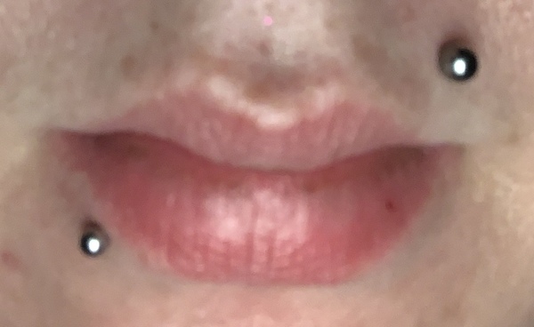 LIP FILLERS!!!!