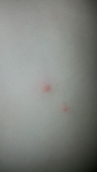 is this chickenpox rash?
