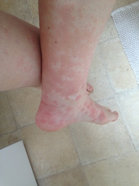 Experience of hives?