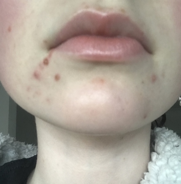 can you help my dd please...spotty chin