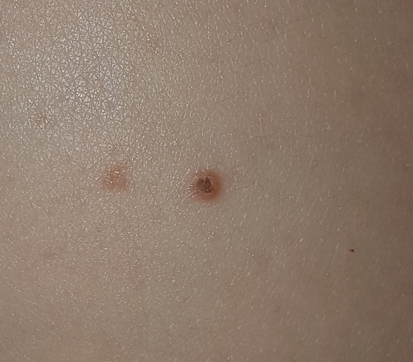 Does this mole look dodgy?