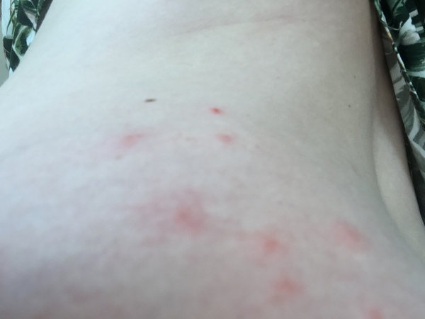 Help me identify this rash