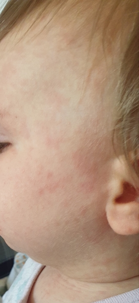 Fever and a rash