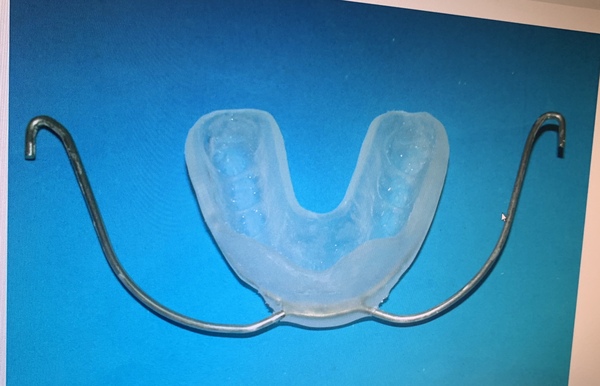 What is this type of brace called?