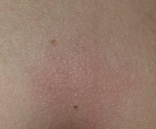Yuk! Slightly infected sebaceous cyst - will it settle in its own?
