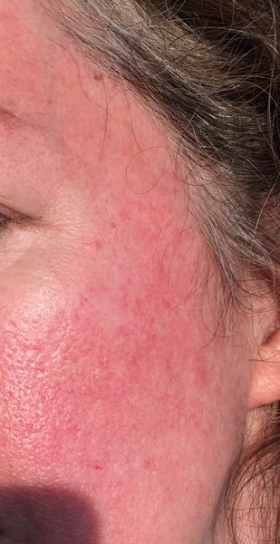 Congested sensitive skin and so so unhappy