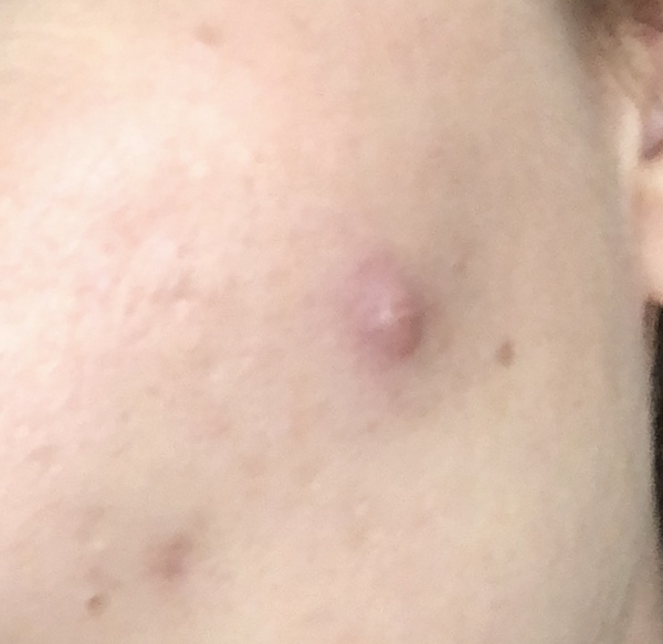 sweet lord someone help me get rid of this monster spot! (Warning - picture included)
