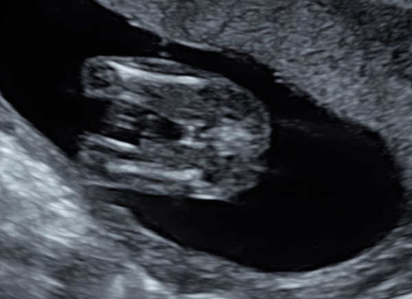 Anyone worried their private gender scan is wrong?