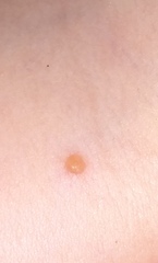 To ask if this looks like chicken pox?