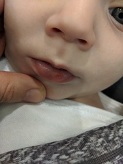 Baby coldsore?