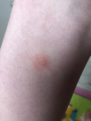 Help. Urgent. Is this chickenpox or just hives?