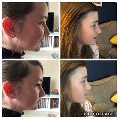 Twin Block Braces - Any Advice?
