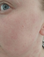 So what's this rash then?!