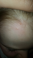is this chickenpox rash?