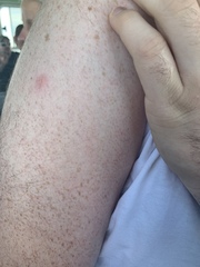 To think I’m staying in a bed bug infested hotel?