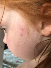 Help. Urgent. Is this chickenpox or just hives?