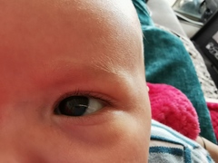 Baby's eyes different shape