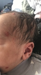 HSV1 and Pregnancy/Childbirth + neonatal herpes experience