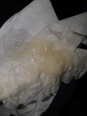 is this discharge normal *warning picture*