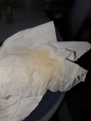 is this discharge normal *warning picture*