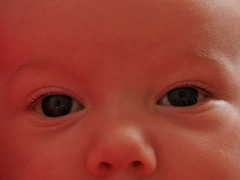 Baby's eyes different shape