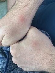 To think I’m staying in a bed bug infested hotel?