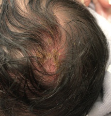 HSV1 and Pregnancy/Childbirth + neonatal herpes experience