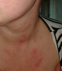 So what's this rash then?!