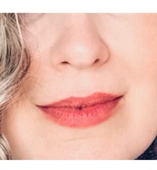 LIP FILLERS!!!!