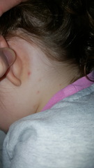 is this chickenpox rash?