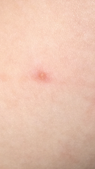 To ask if this looks like chicken pox?