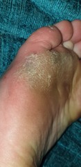 Is this just a callus or something worse?