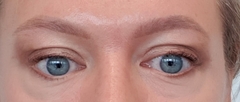 Anyone had upper & lower eyelid surgery?