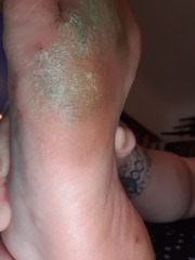 Is this just a callus or something worse?