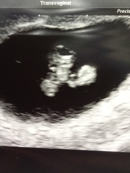 The Graduates of TTC after pregnancy loss thread